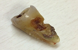 虫歯 (2)
