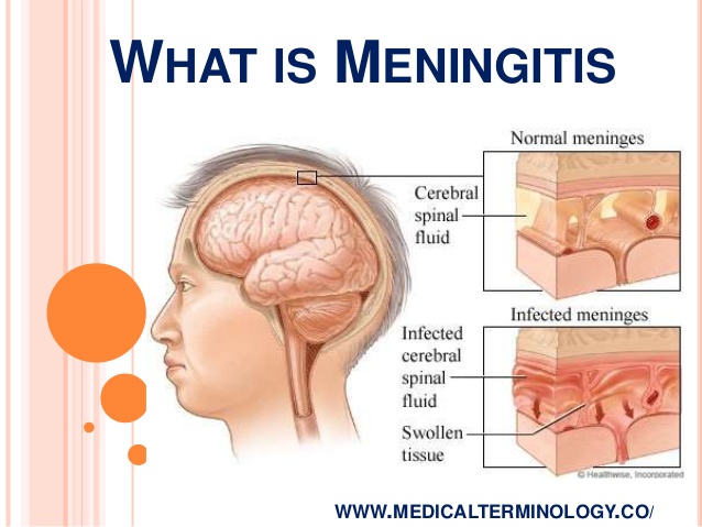 What-is-meningitis.jpg