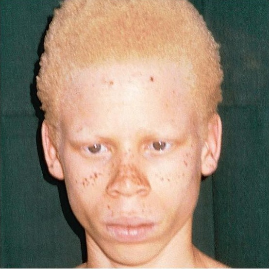 albinism.jpg