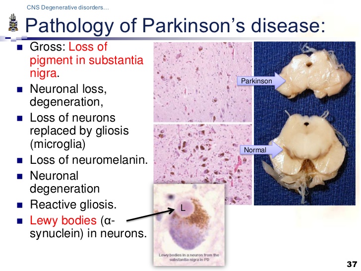pathology-of-cns-degenerations-lecture-37-728.jpg